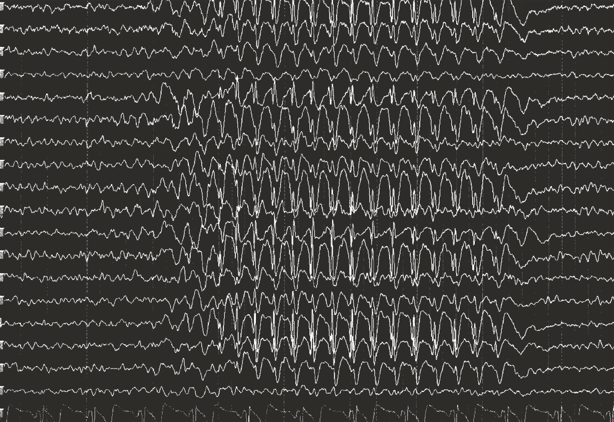 Dziecięca padaczka nieświadomości EEG międzynapadowe zwykle prawidłowe, w czasie napadu charakterystyczne synchroniczne, symetryczne wyładowania zespołów iglica-fala 3Hz. Nie ma fotowrażliwości.