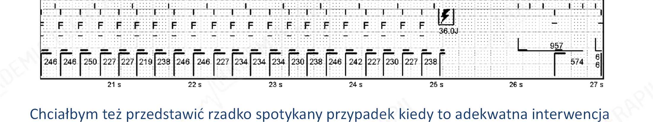 Kardiowersja wywołująca migotanie przedsionków Chciałbym też przedstawić rzadko spotykany przypadek kiedy to adekwatna interwencja