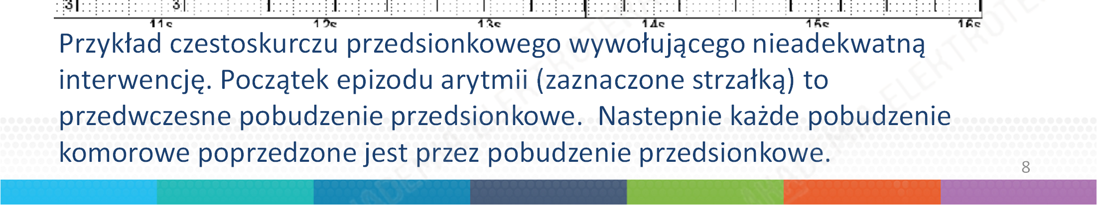 Analiza początku arytmii: Przykład czestoskurczu przedsionkowego wywołującego nieadekwatną interwencję.