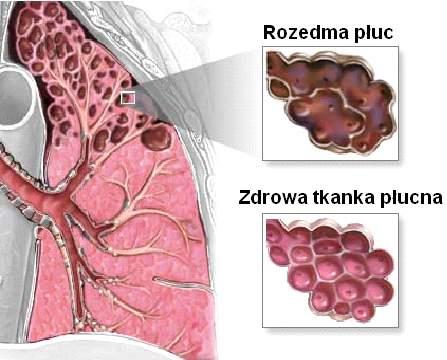 ROZEDMA Rozedma jest to zespół procesów uszkadzających płuca, które najczęściej są rezultatem długotrwałego palenia lub oddychania zanieczyszczonym powietrzem W następstwie dochodzi do: -