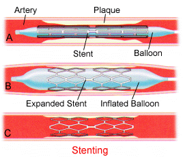 tętnicy 3) Rozprężenie stentu na balonie 4)