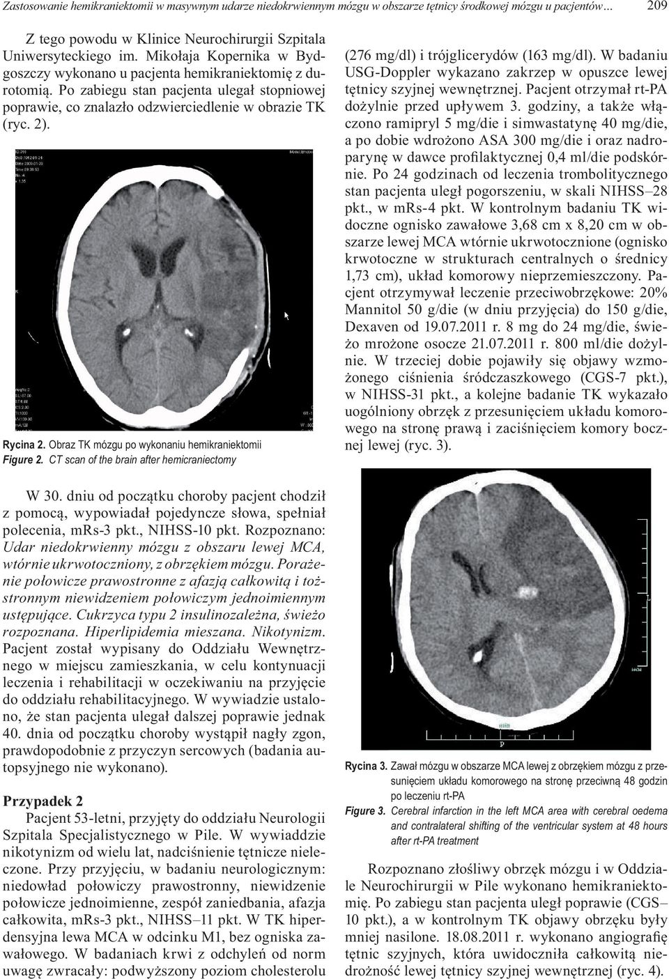 Obraz TK mózgu po wykonaniu hemikraniektomii Figure 2. CT scan of the brain after hemicraniectomy W 30.
