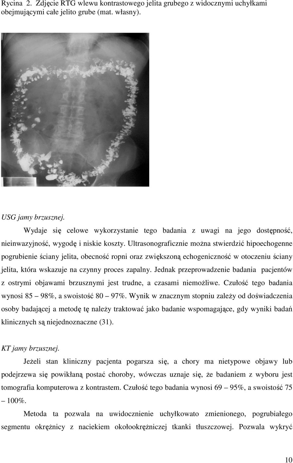 Ultrasonograficznie moŝna stwierdzić hipoechogenne pogrubienie ściany jelita, obecność ropni oraz zwiększoną echogeniczność w otoczeniu ściany jelita, która wskazuje na czynny proces zapalny.