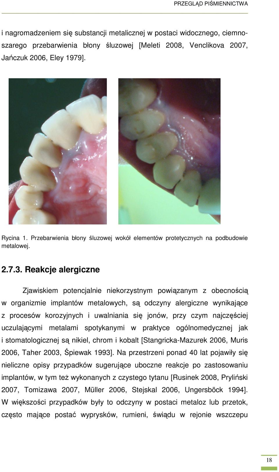 Reakcje alergiczne Zjawiskiem potencjalnie niekorzystnym powiązanym z obecnością w organizmie implantów metalowych, są odczyny alergiczne wynikające z procesów korozyjnych i uwalniania się jonów,