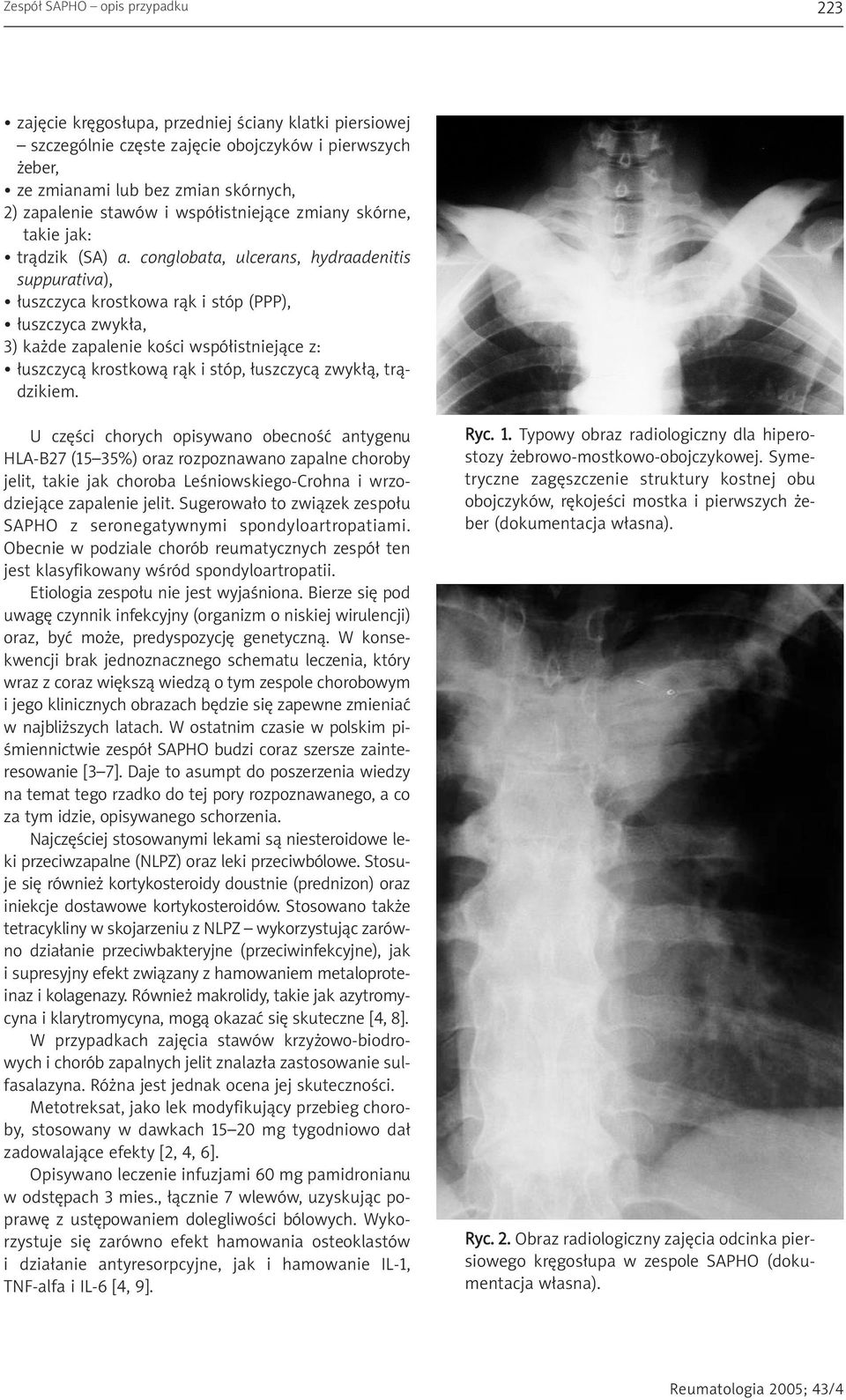 conglobata, ulcerans, hydraadenitis suppurativa), ³uszczyca krostkowa r¹k i stóp (PPP), ³uszczyca zwyk³a, 3) ka de zapalenie koœci wspó³istniej¹ce z: ³uszczyc¹ krostkow¹ r¹k i stóp, ³uszczyc¹ zwyk³¹,