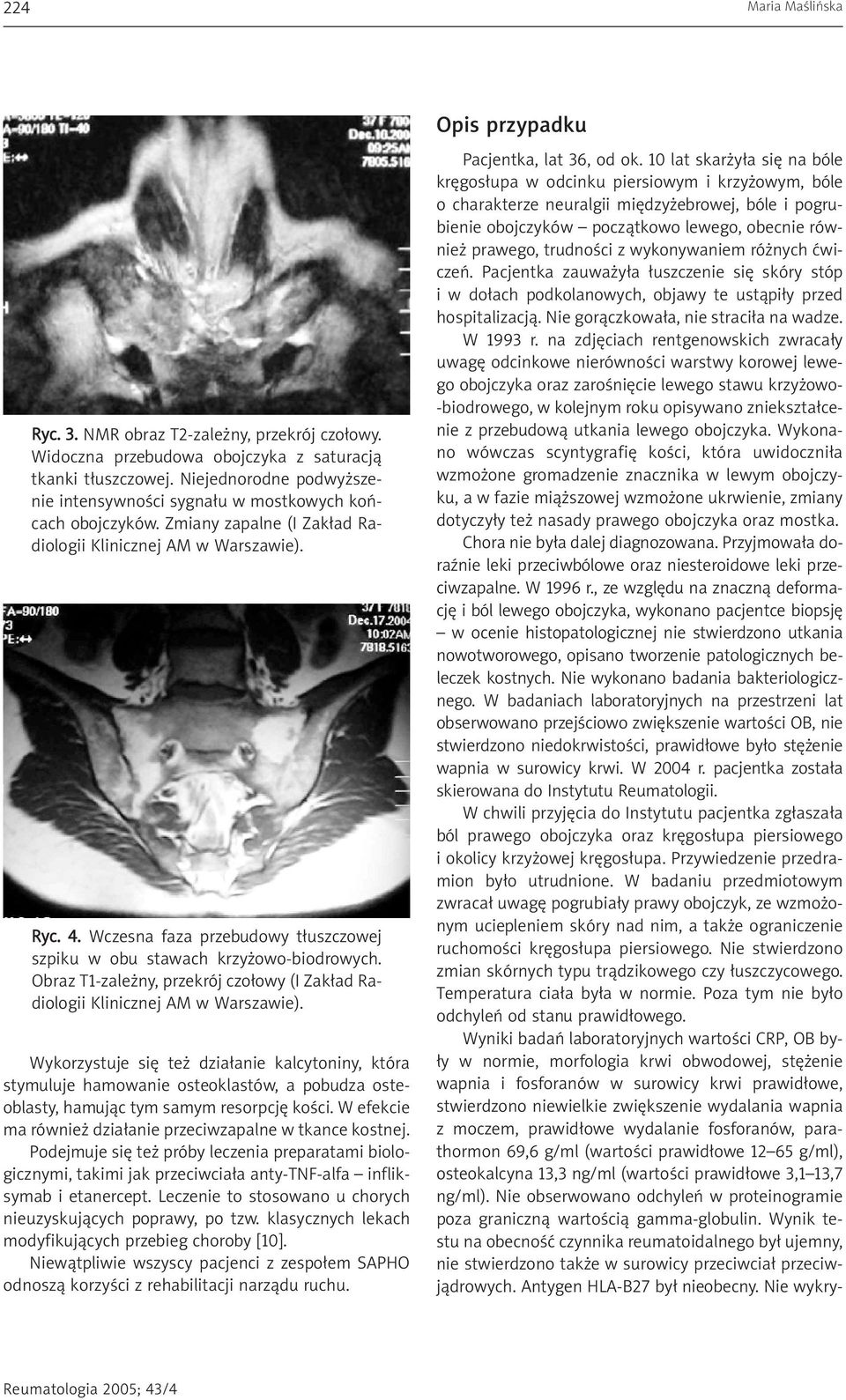 Wczesna faza przebudowy t³uszczowej szpiku w obu stawach krzy owo-biodrowych. Obraz T1-zale ny, przekrój czo³owy (I Zak³ad Radiologii Klinicznej AM w Warszawie).
