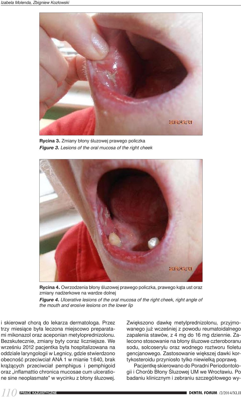 Ulcerative lesions of the oral mucosa of the right cheek, right angle of the mouth and erosive lesions on the lower lip i skierował chorą do lekarza dermatologa.