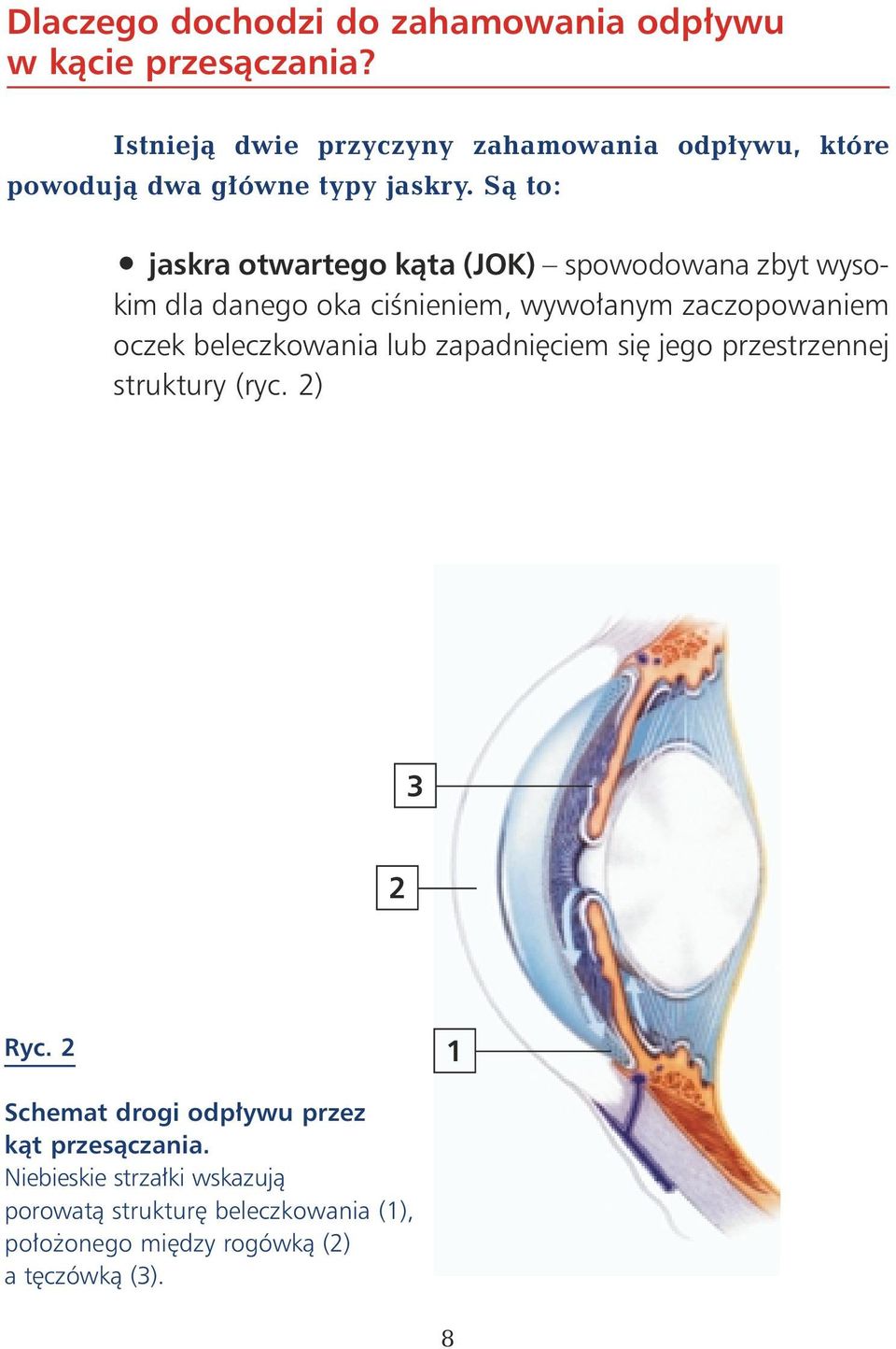 Sà to: jaskra otwartego kàta (JOK) spowodowana zbyt wysokim dla danego oka ciênieniem, wywo anym zaczopowaniem oczek
