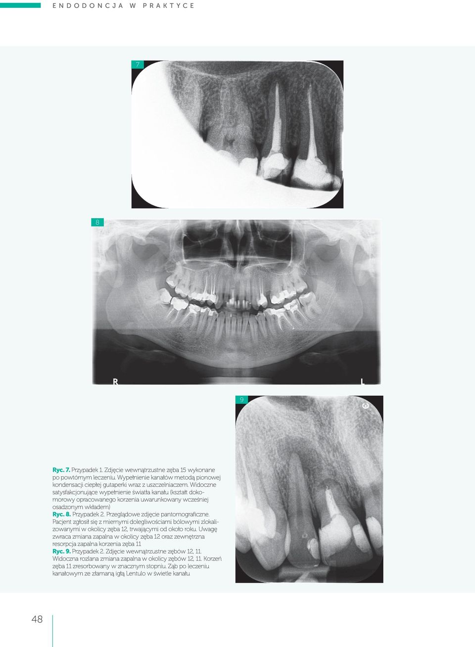 Pacjent zgłosił się z miernymi dolegliwościami bólowymi zlokalizowanymi w okolicy zęba 12, trwającymi od około roku.
