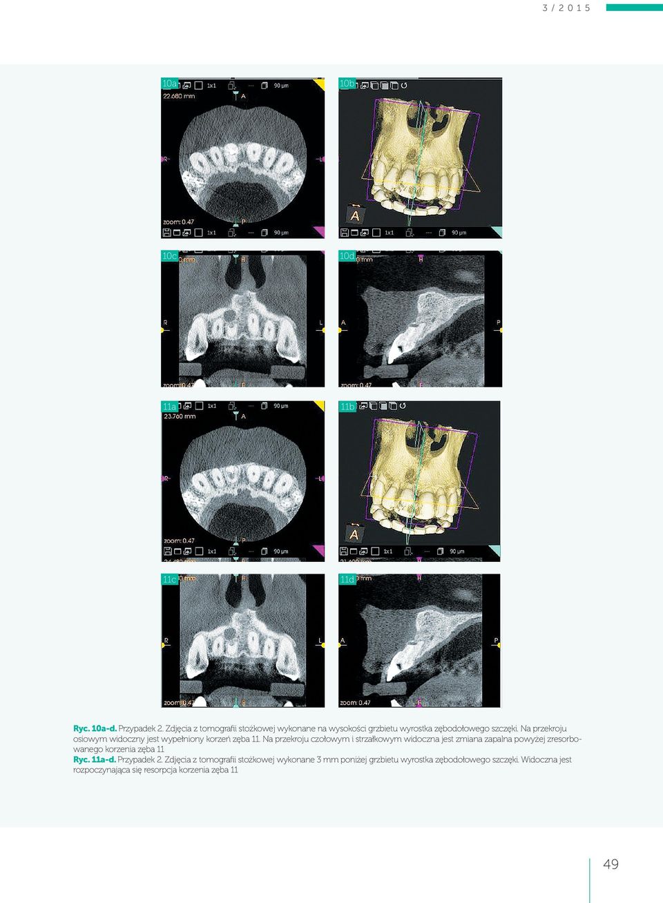 Na przekroju osiowym widoczny jest wypełniony korzeń zęba 11.
