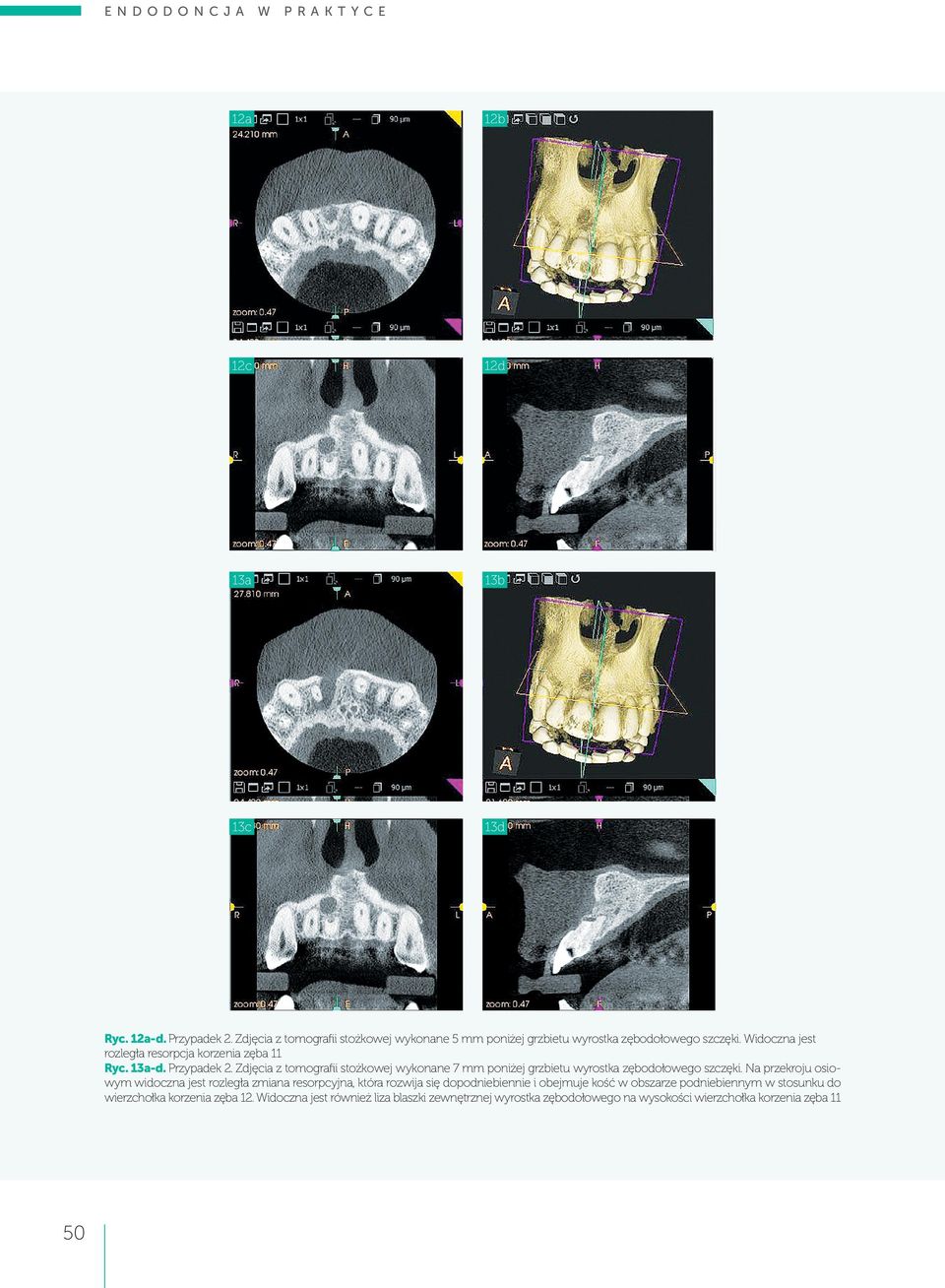 Przypadek 2. Zdjęcia z tomografii stożkowej wykonane 7 mm poniżej grzbietu wyrostka zębodołowego szczęki.