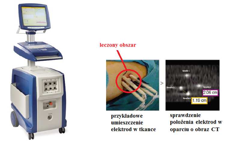 komórkowej w metodzie IRE. Urządzenie wytwarza serię impulsów elektrycznych o amplitudzie (100 3000) V i czasie trwania (20 100) µs.