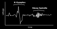 pacjentów z epilepsją, w obszarze ogniska epileptycznego. Kompleks K i wrzeciono snu Wrzeciona snu (ang. sleep spindles) (rys.