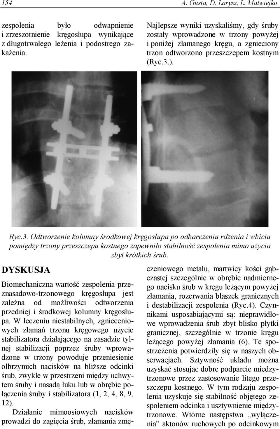 ). Ryc.3. Odtworzenie kolumny środkowej kręgosłupa po odbarczeniu rdzenia i wbiciu pomiędzy trzony przeszczepu kostnego zapewniło stabilność zespolenia mimo użycia zbyt krótkich śrub.