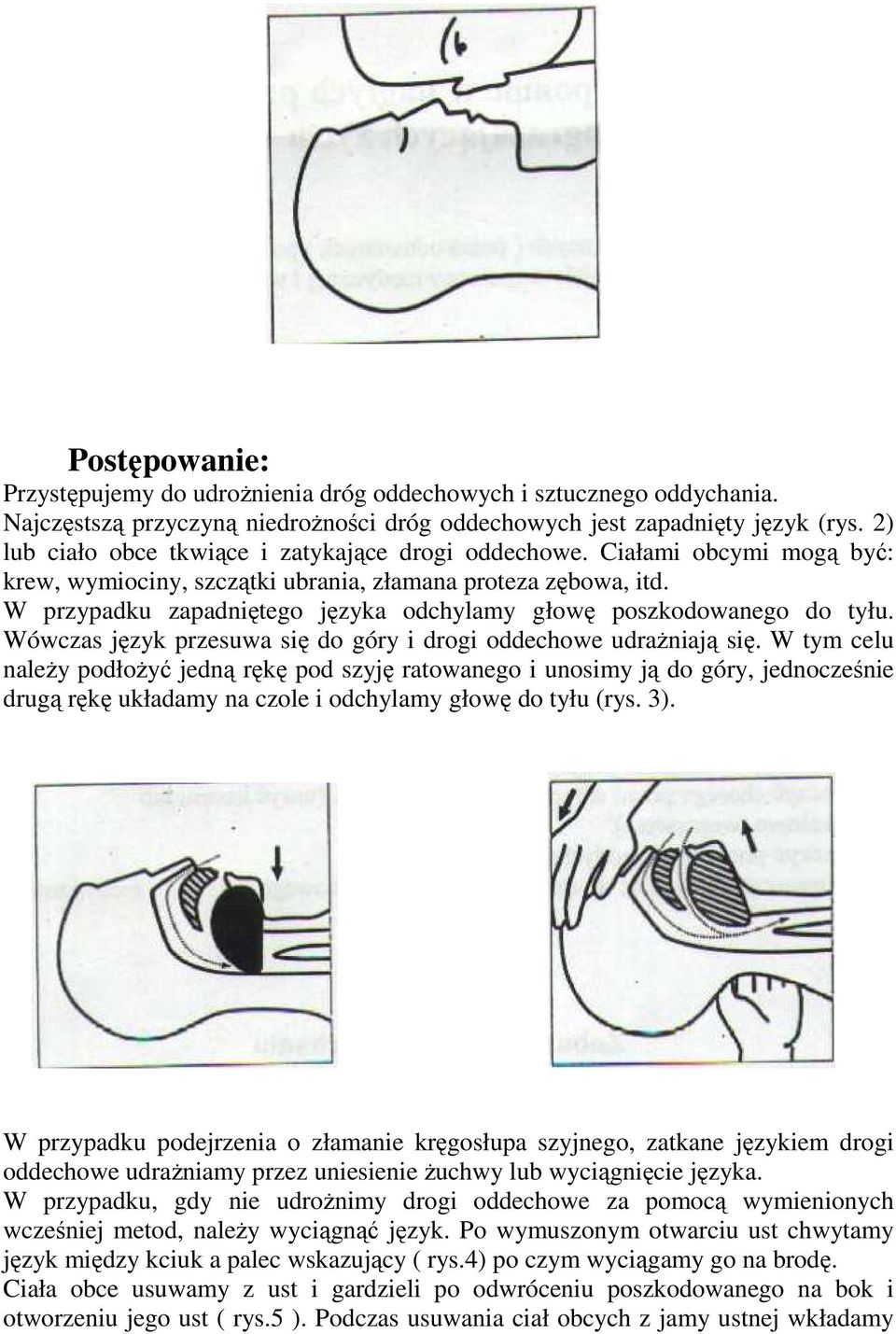 W przypadku zapadniętego języka odchylamy głowę poszkodowanego do tyłu. Wówczas język przesuwa się do góry i drogi oddechowe udraŝniają się.