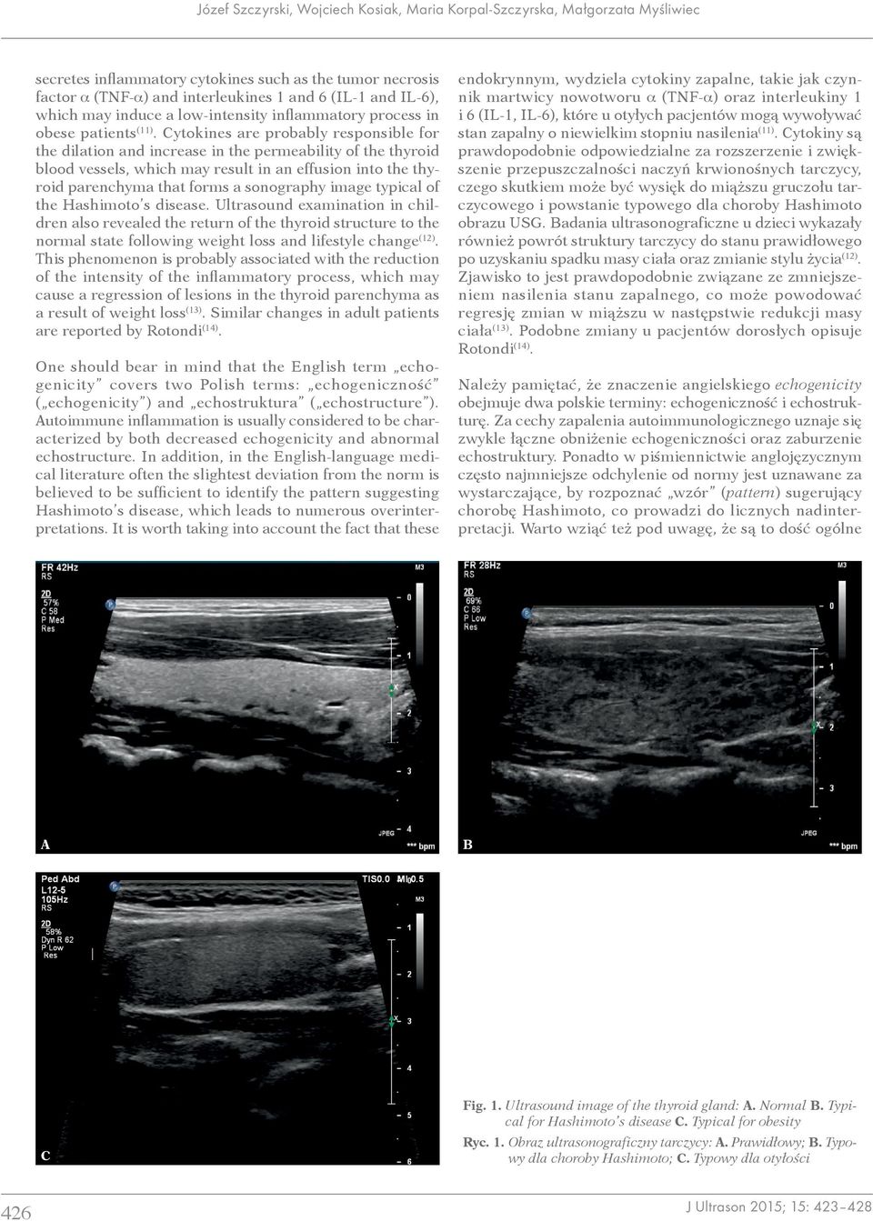 Cytokines are probably responsible for the dilation and increase in the permeability of the thyroid blood vessels, which may result in an effusion into the thyroid parenchyma that forms a sonography