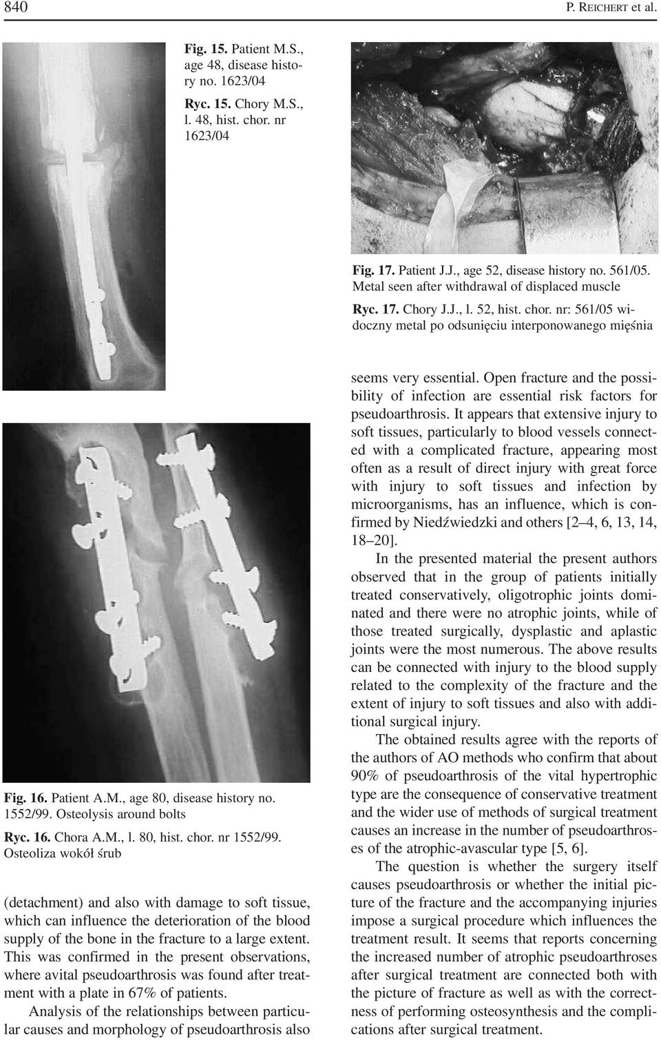 1552/99. Osteolysis around bolts Ryc. 16. Chora A.M., l. 80, hist. chor. nr 1552/99.