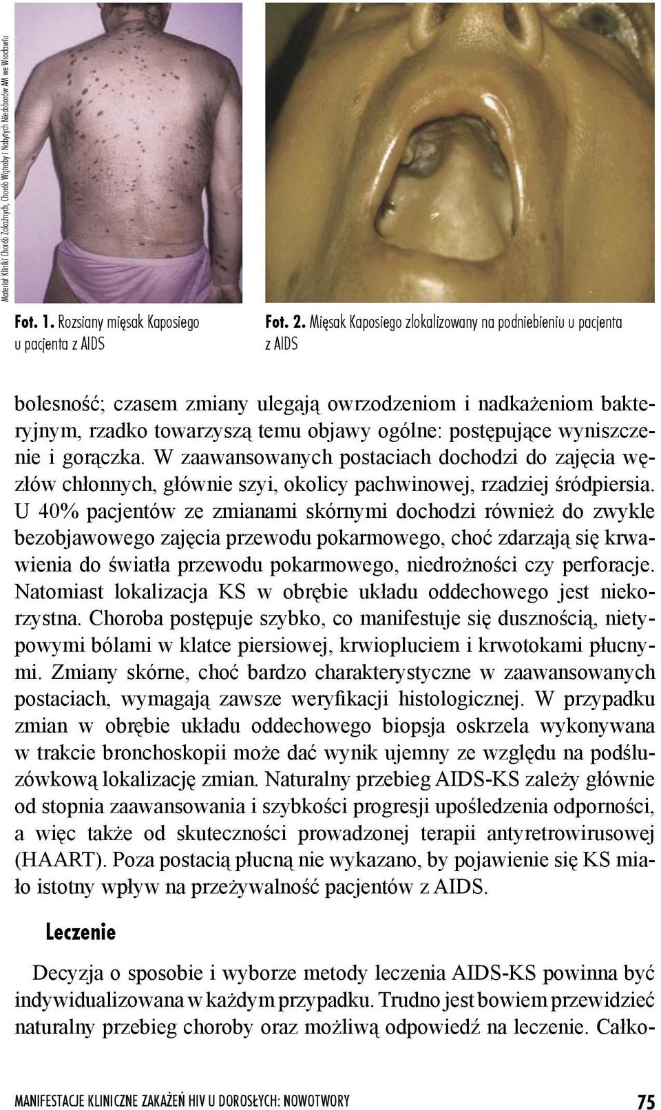 wyniszczenie i gorączka. W zaawansowanych postaciach dochodzi do zajęcia węzłów chłonnych, głównie szyi, okolicy pachwinowej, rzadziej śródpiersia.