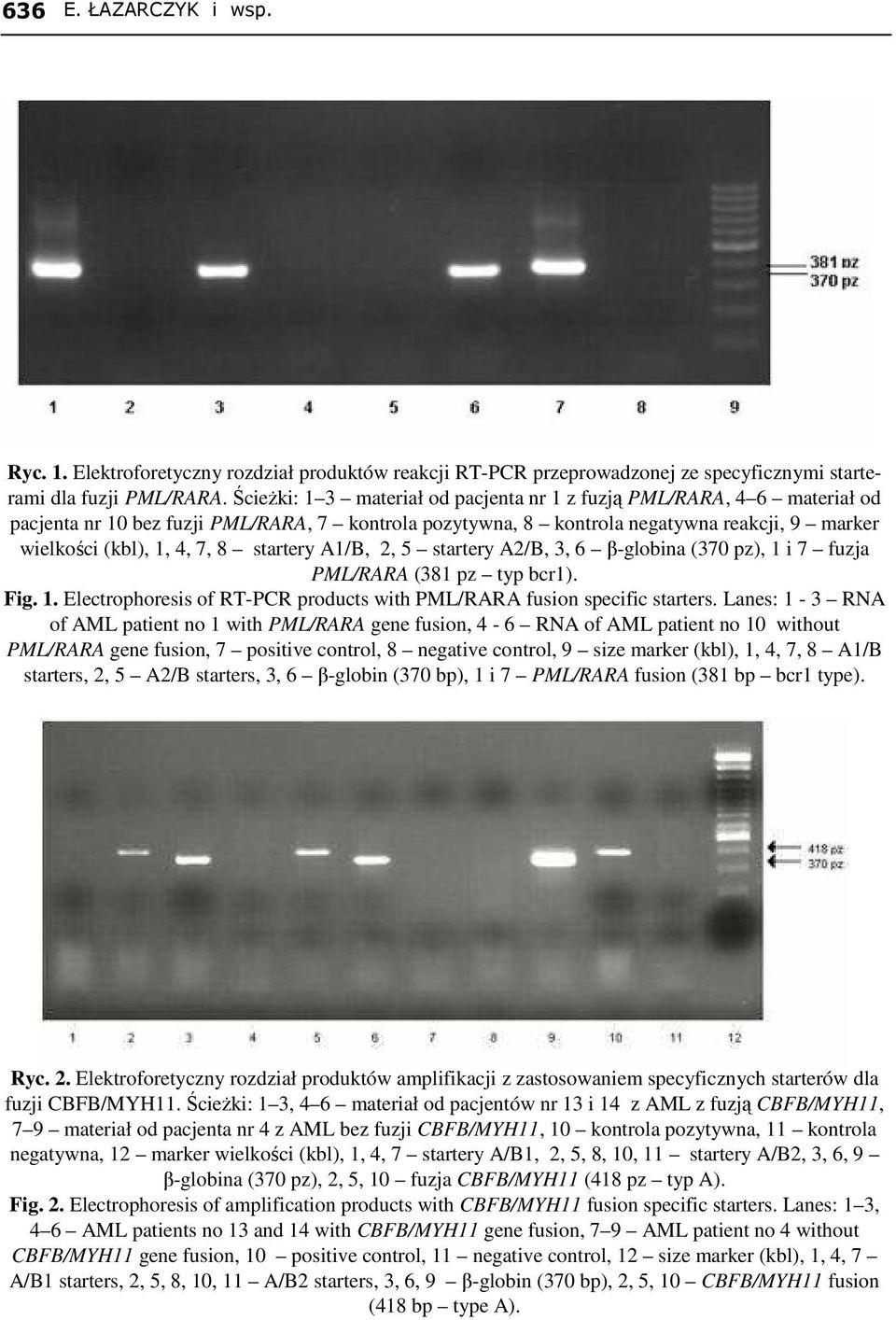 startery A1/B, 2, 5 startery A2/B, 3, 6 β-globina (370 pz), 1 i 7 fuzja PML/RARA (381 pz typ bcr1). Fig. 1. Electrophoresis of RT-PCR products with PML/RARA fusion specific starters.