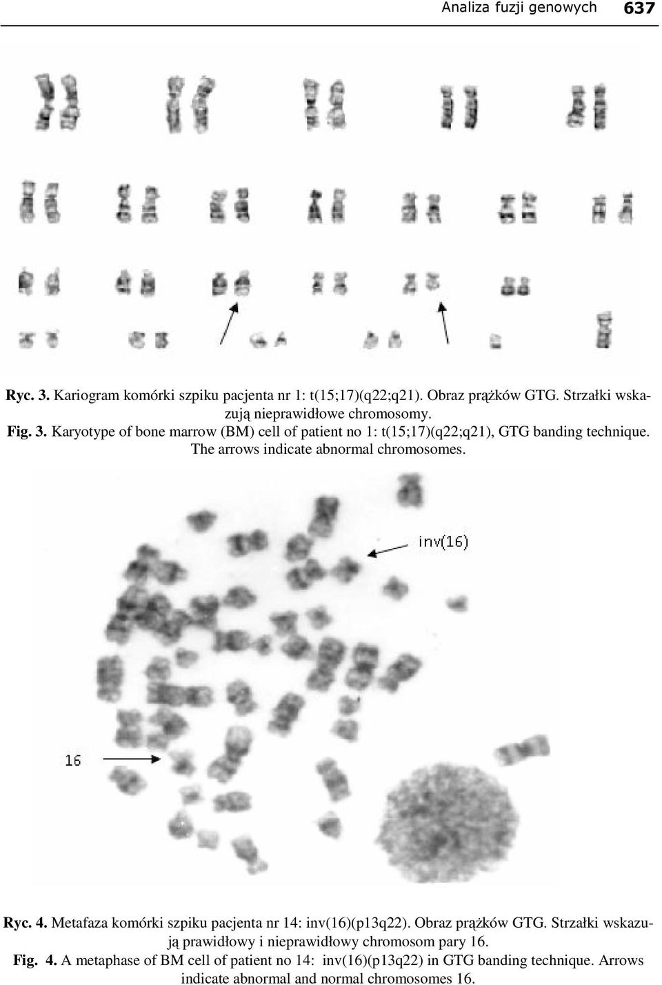 The arrows indicate abnormal chromosomes. Ryc. 4. Metafaza komórki szpiku pacjenta nr 14: inv(16)(p13q22). Obraz prąŝków GTG.