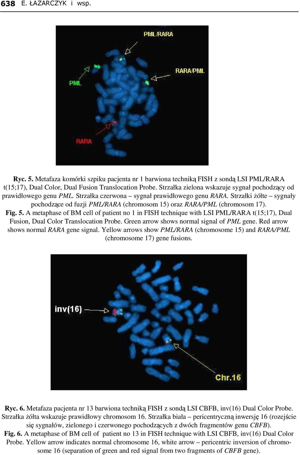 Strzałki Ŝółte sygnały pochodzące od fuzji PML/RARA (chromosom 15) oraz RARA/PML (chromosom 17). Fig. 5.