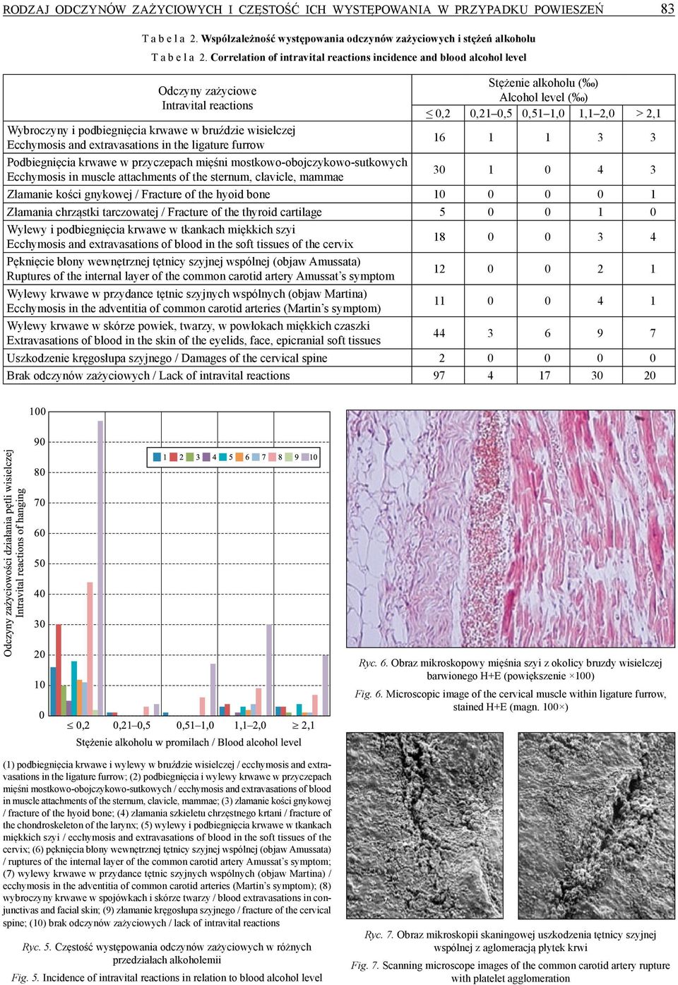 podbiegnięcia krwawe w bruździe wisielczej Ecchymosis and extravasations in the ligature furrow 16 1 1 3 3 Podbiegnięcia krwawe w przyczepach mięśni mostkowo-obojczykowo-sutkowych Ecchymosis in