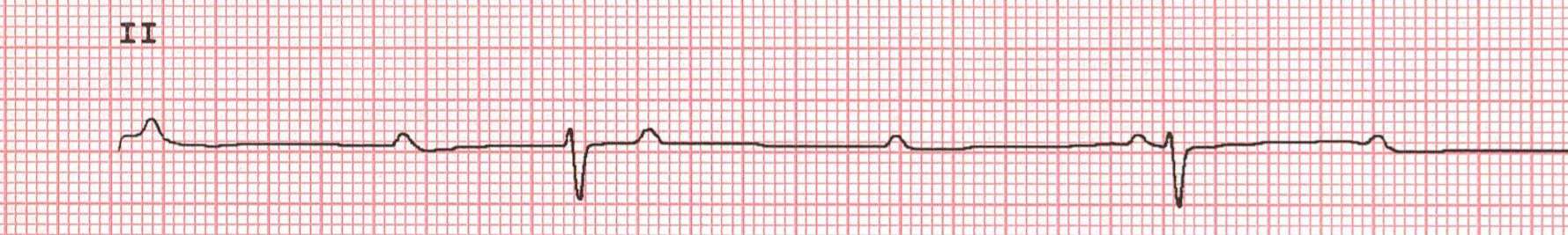 P P P P P P QRS QRS QT 1. Jaki to rytm? 2.