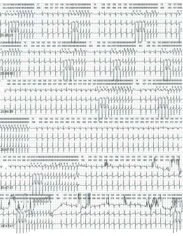 HOLTER EKG w