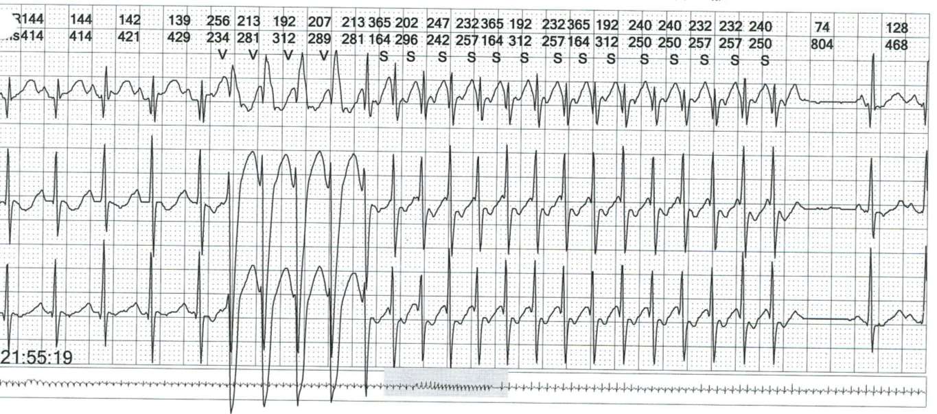 HOLTER EKG w 2 dobie życia wstawki częstoskurczu samoistnie