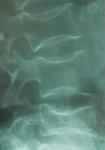 RYZYKO ZŁAMANIA BKK UDOWEJ PO PIERWSZYM ZŁAMANIU K. promieniowa 2 x Ortopeda jest pierwszym i najczęściej ostatnim lekarzem pacjenta ze złamaniem osteoporotycznym.