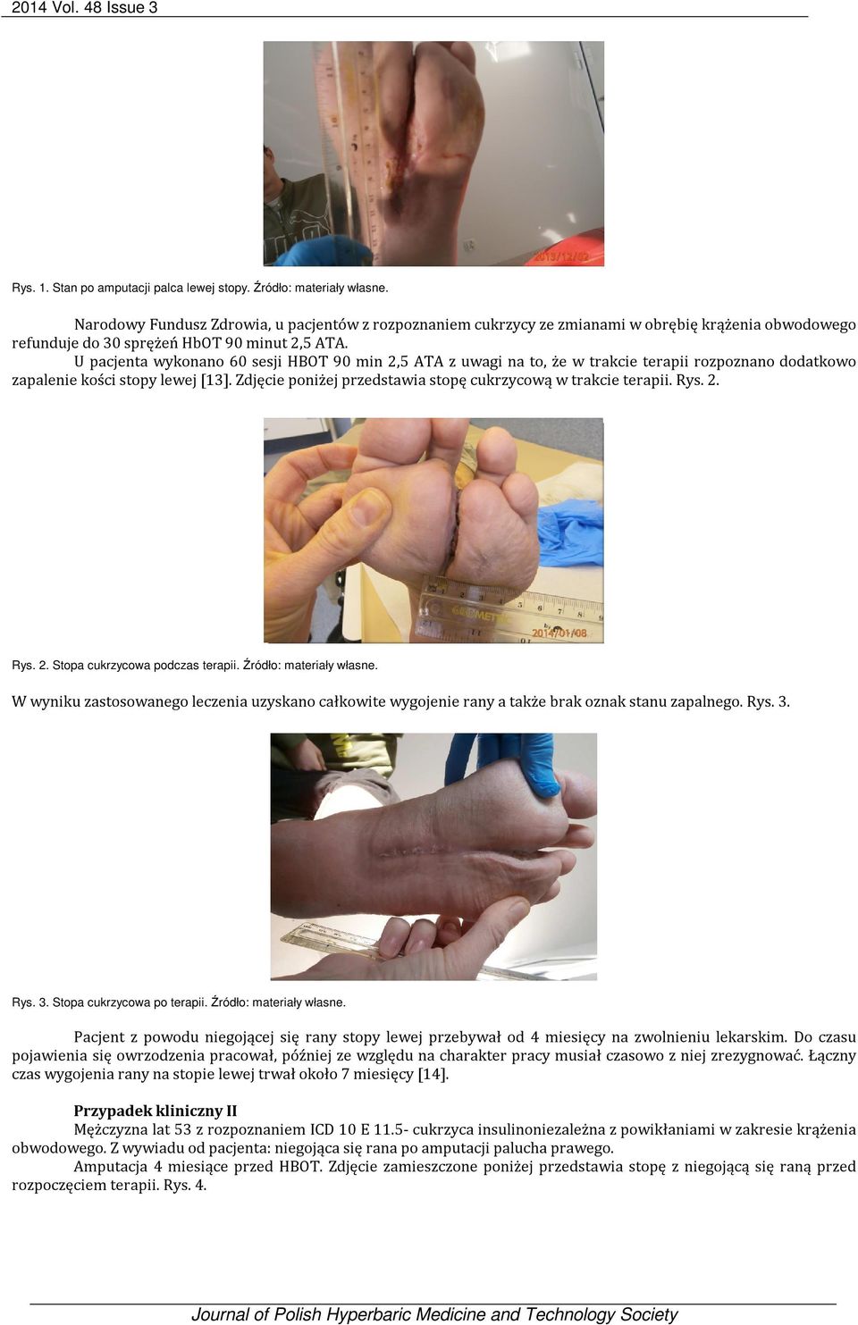 U pacjenta wykonano 60 sesji HBOT 90 min 2,5 ATA z uwagi na to, że w trakcie terapii rozpoznano dodatkowo zapalenie kości stopy lewej [13].