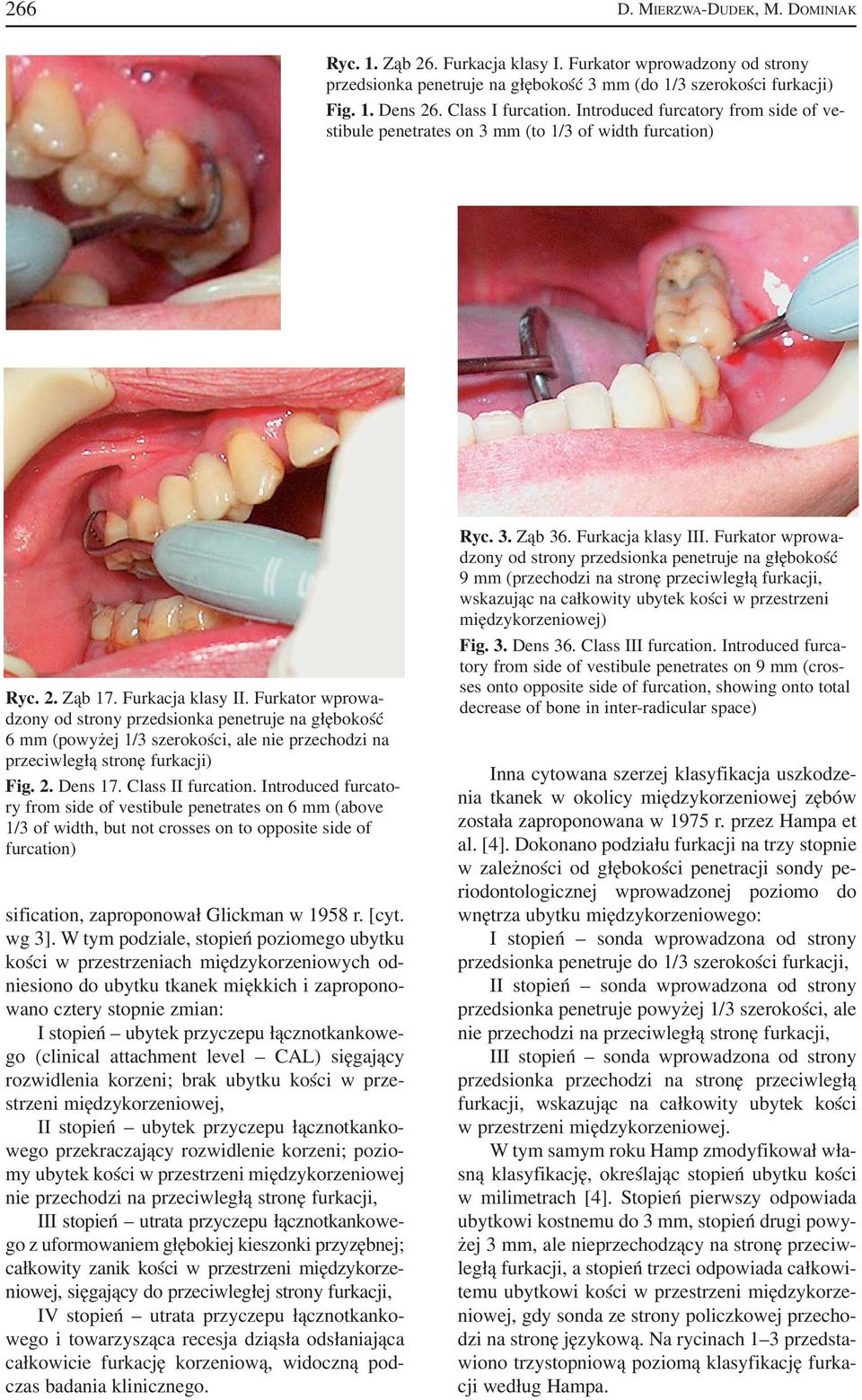 Furkator wprowa dzony od strony przedsionka penetruje na głębokość 6 mm (powyżej 1/3 szerokości, ale nie przechodzi na przeciwległą stronę furkacji) Fig. 2. Dens 17. Class II furcation.