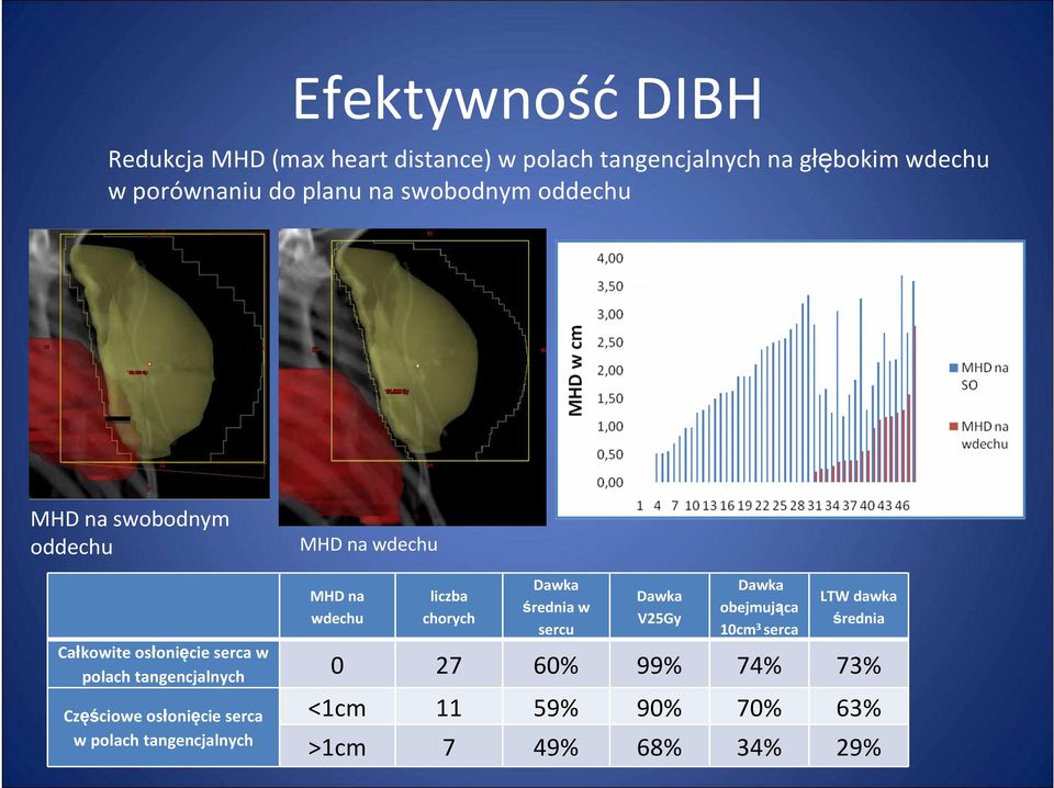 sercu Dawka V25Gy Dawka obejmująca 10cm 3 serca LTW dawka średnia Całkowite osłonięcie serca w polach