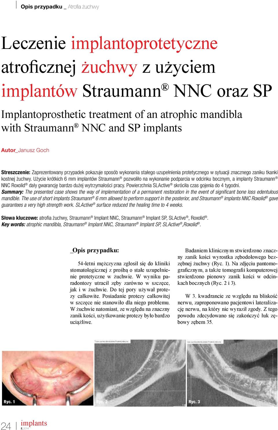 Użycie krótkich 6 mm implantów Straumann pozwoliło na wykonanie podparcia w odcinku bocznym, a implanty Straumann NNC Roxolid dały gwarancję bardzo dużej wytrzymałości pracy.