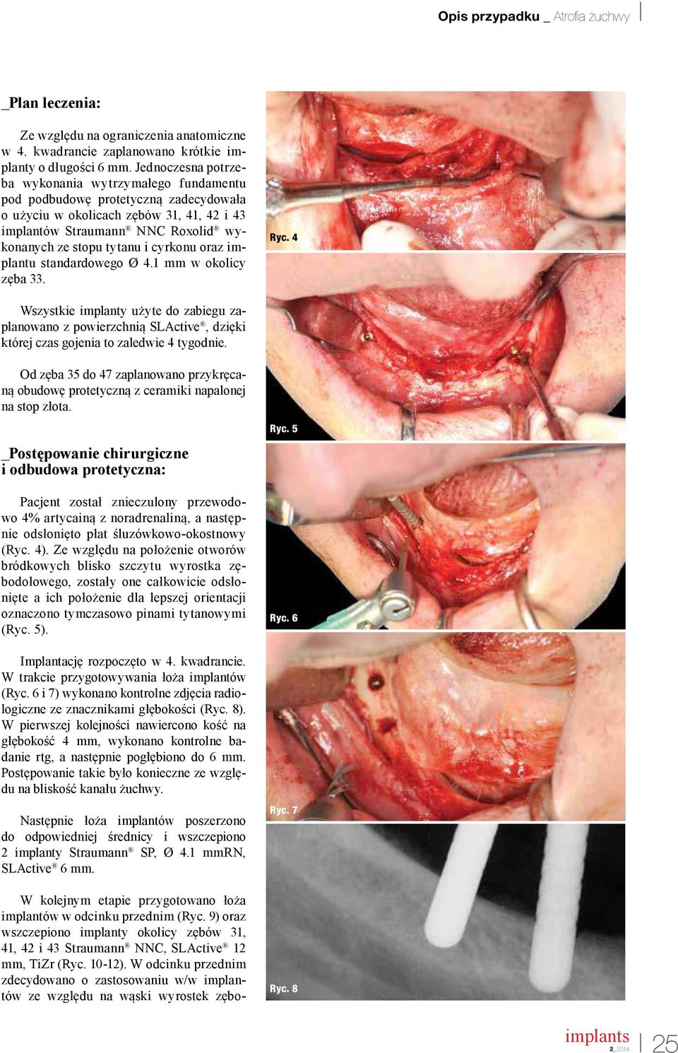 cyrkonu oraz implantu standardowego Ø 4.1 mm w okolicy zęba 33. Ryc. 4 Wszystkie implanty użyte do zabiegu zaplanowano z powierzchnią SLActive, dzięki której czas gojenia to zaledwie 4 tygodnie.