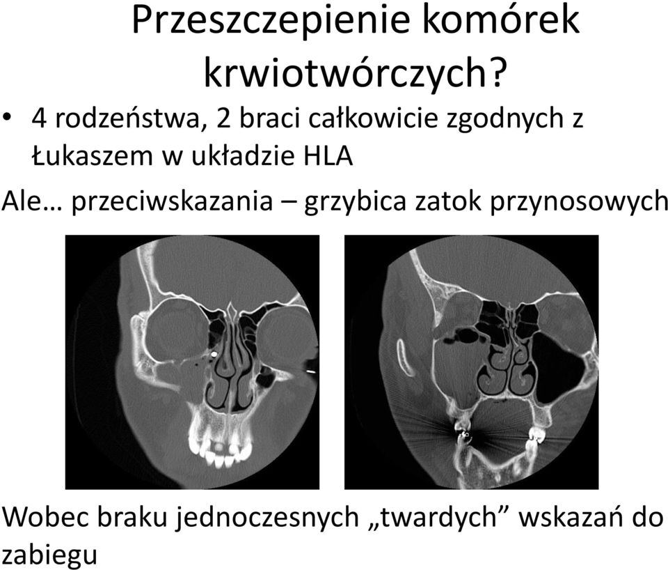 w układzie HLA Ale przeciwskazania grzybica zatok