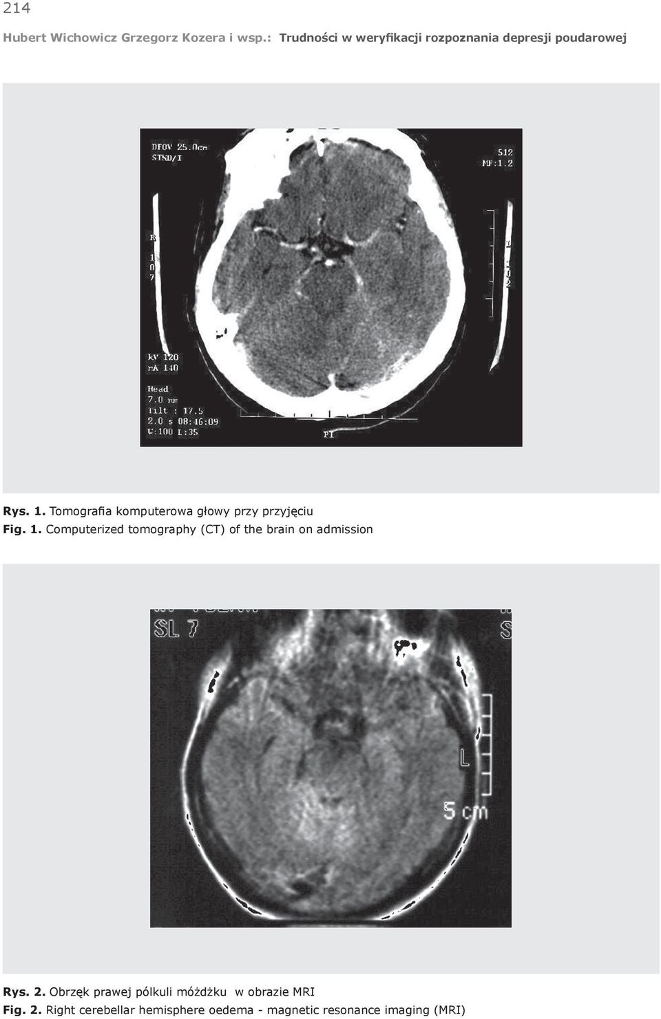 2. Obrzęk prawej pólkuli móżdżku w obrazie MRI Fig. 2.