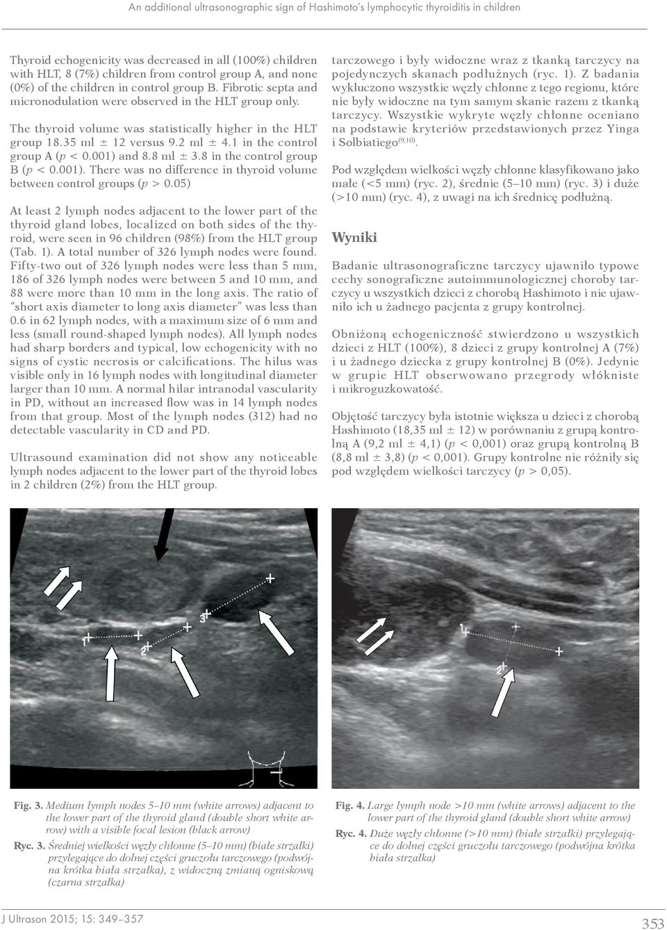 35 ml ± 12 versus 9.2 ml ± 4.1 in the control group A (p < 0.001) and 8.8 ml ± 3.8 in the control group B (p < 0.001). There was no difference in thyroid volume between control groups (p > 0.