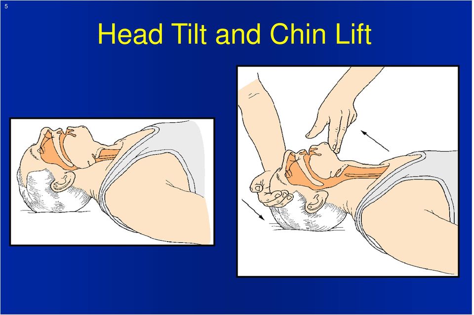 Chin Lift