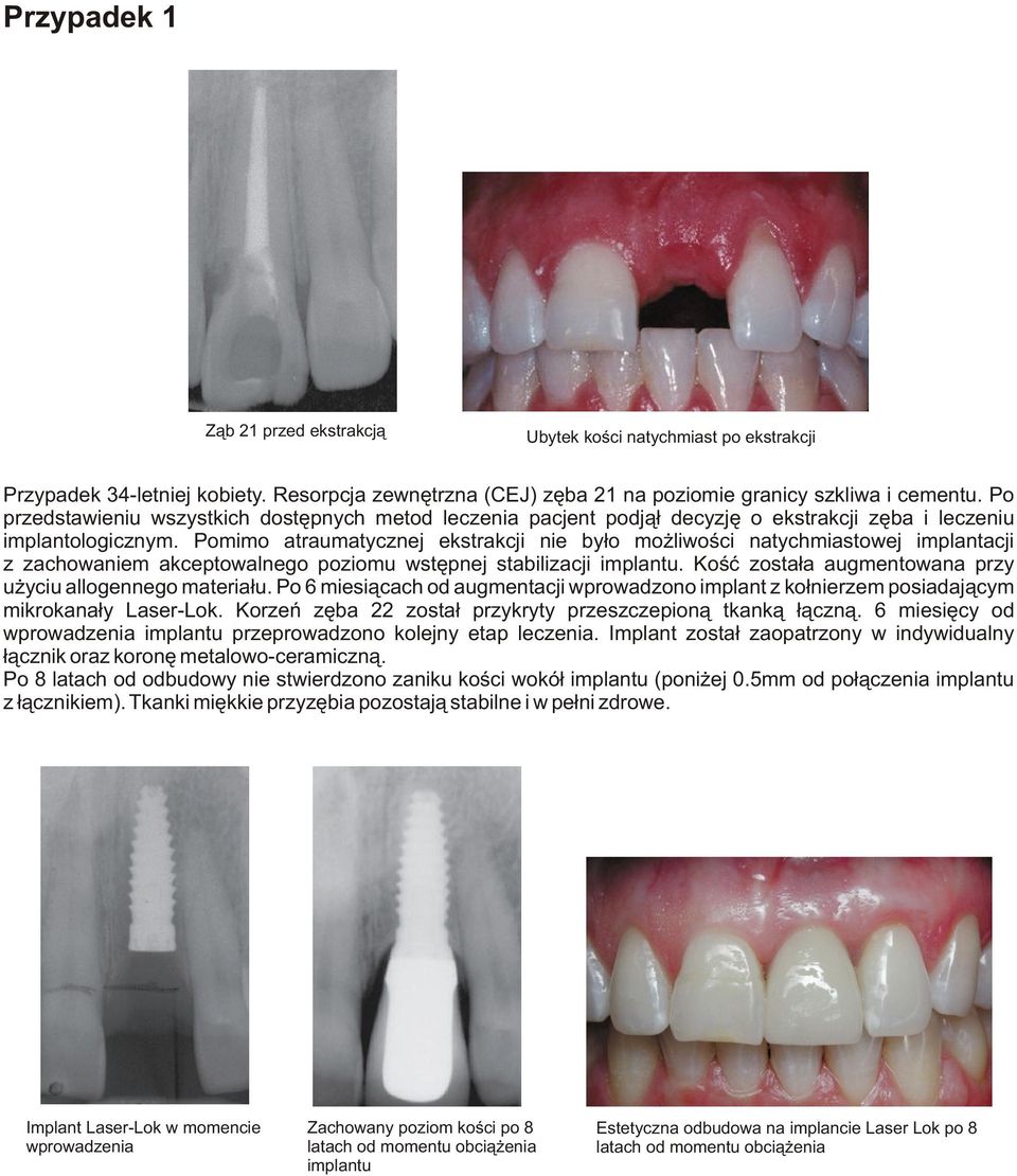 Pomimo atraumatycznej ekstrakcji nie by³o mo liwoœci natychmiastowej implantacji z zachowaniem akceptowalnego poziomu wstêpnej stabilizacji implantu.