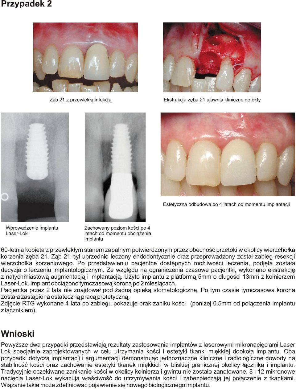 Z¹b 21 by³ uprzednio leczony endodontycznie oraz przeprowadzony zosta³ zabieg resekcji wierzcho³ka korzeniowego.