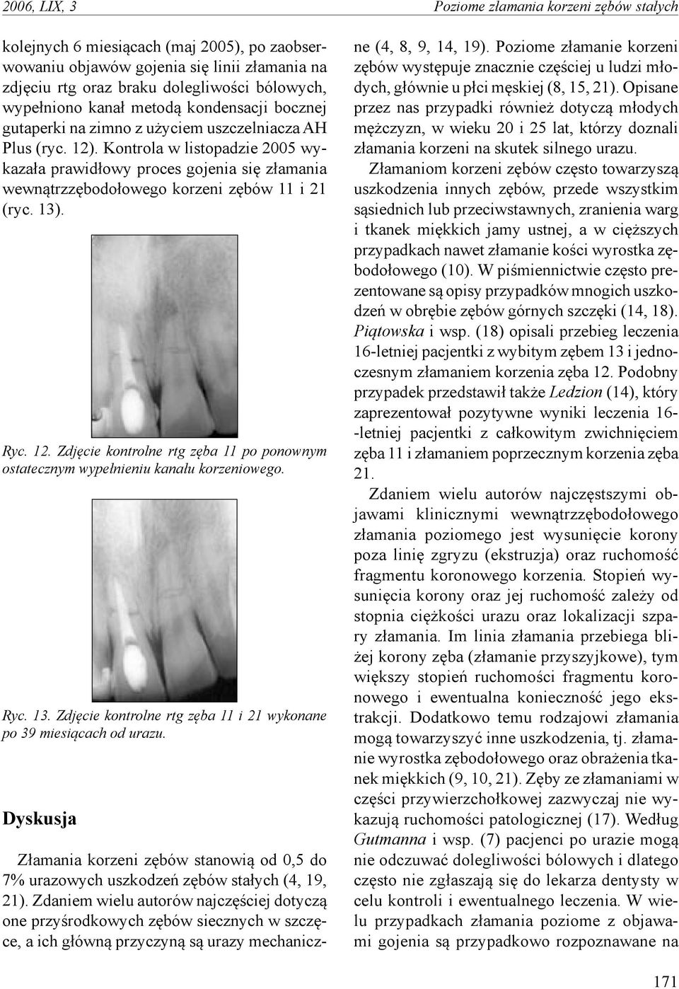 Kontrola w listopadzie 2005 wykazała prawidłowy proces gojenia się złamania wewnątrzzębodołowego korzeni zębów 11 i 21 (ryc. 13). Ryc. 12.