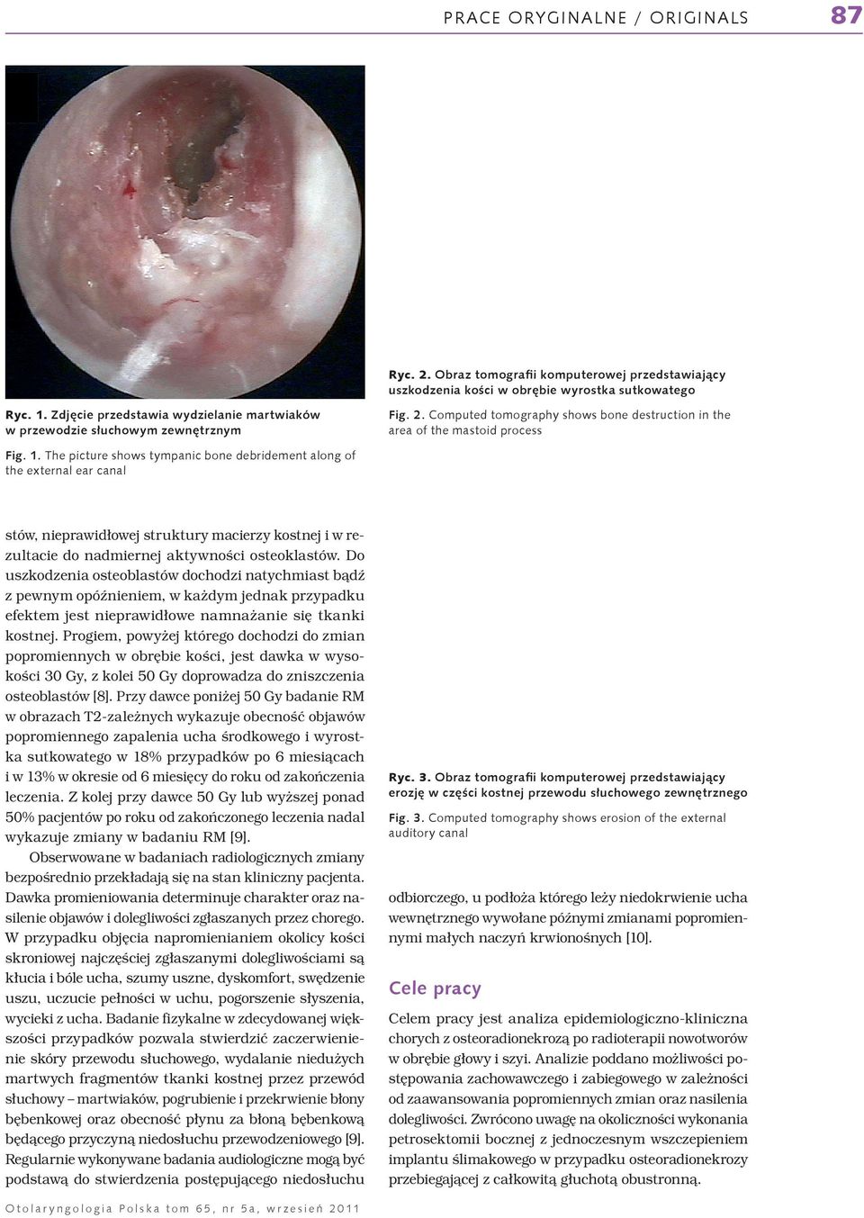 The picture shows tympanic bone debridement along of the external ear canal stów, nieprawidłowej struktury macierzy kostnej i w rezultacie do nadmiernej aktywności osteoklastów.