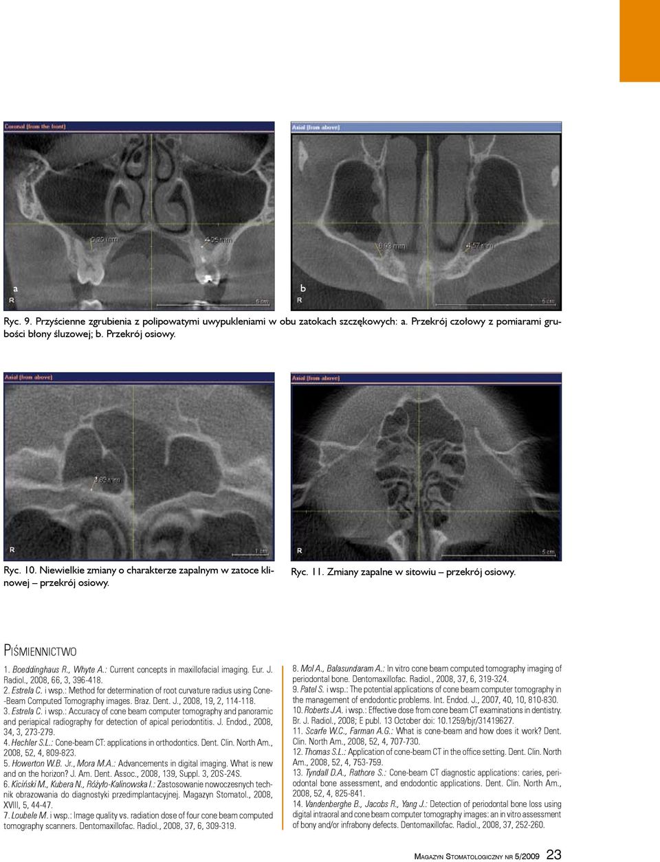 : Current concepts in maxillofacial imaging. Eur. J. Radiol., 2008, 66, 3, 396 418. 2. Estrela C. i wsp.: Method for determination of root curvature radius using Cone Beam Computed Tomography images.