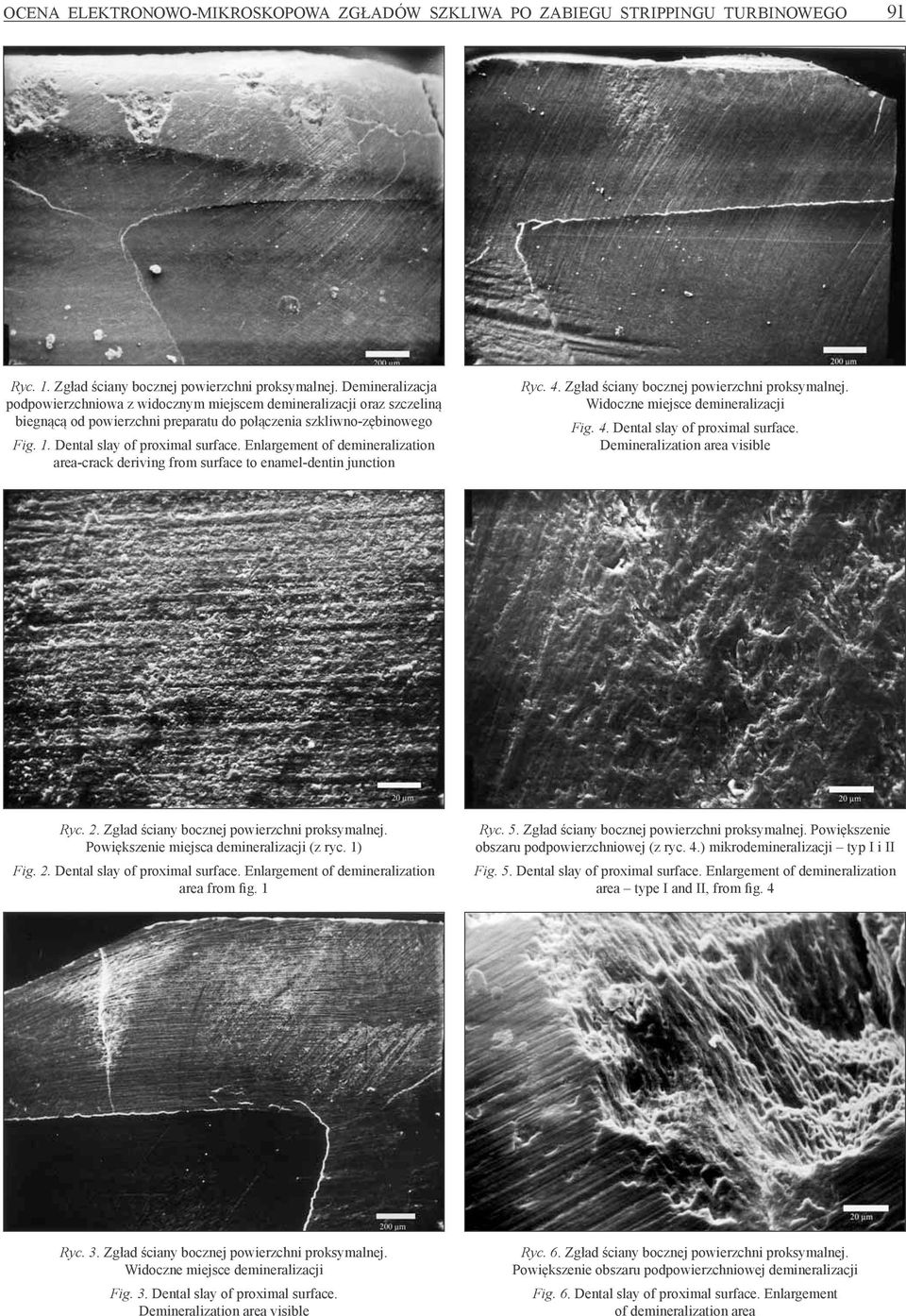 Enlargement of demineralization area-crack deriving from surface to enamel-dentin junction Ryc. 4. Zgład ściany bocznej powierzchni proksymalnej. Widoczne miejsce demineralizacji Fig. 4. Dental slay of proximal surface.