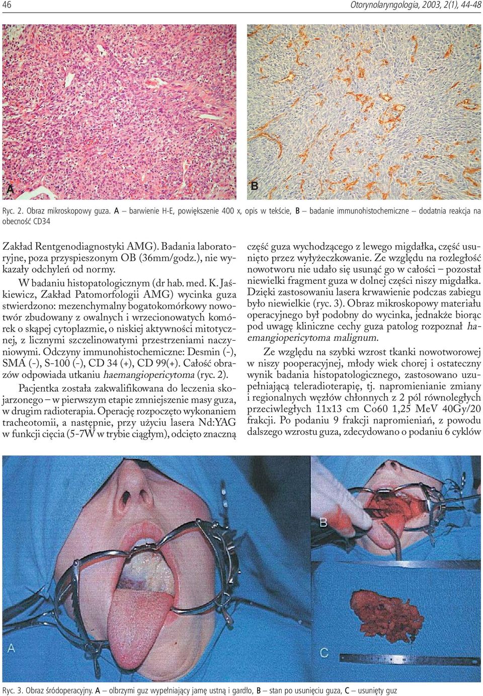 Badania laboratoryjne, poza przyspieszonym OB (36mm/godz.), nie wykaza³y odchyleñ od normy. W badaniu histopatologicznym (dr hab. med. K.