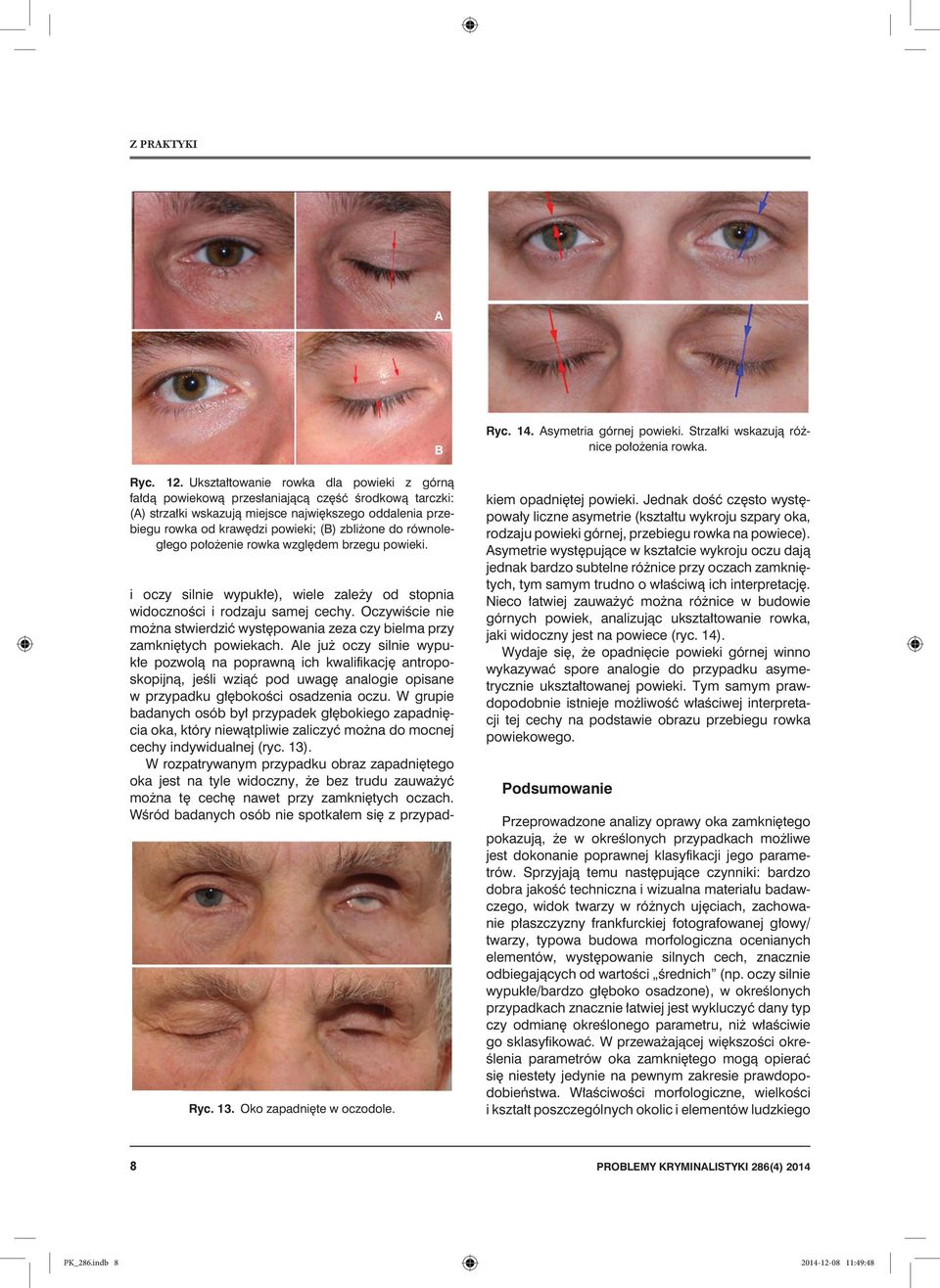 do równoległego położenie rowka względem brzegu powieki. Ryc. 13. Oko zapadnięte w oczodole. B Ryc. 14. Asymetria górnej powieki. Strzałki wskazują różnice położenia rowka.