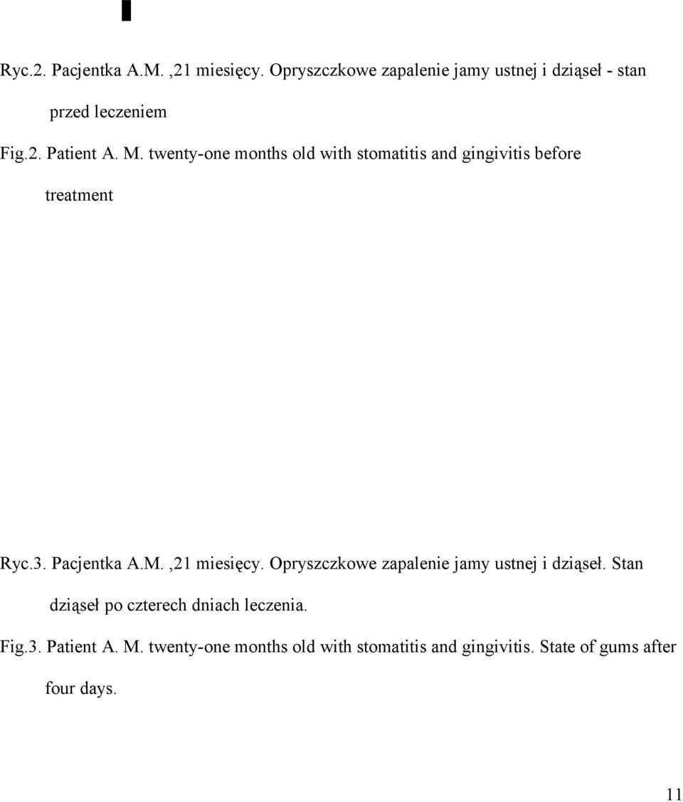 M.,21 miesięcy. Opryszczkowe zapalenie jamy ustnej i dziąseł. Stan dziąseł po czterech dniach leczenia.
