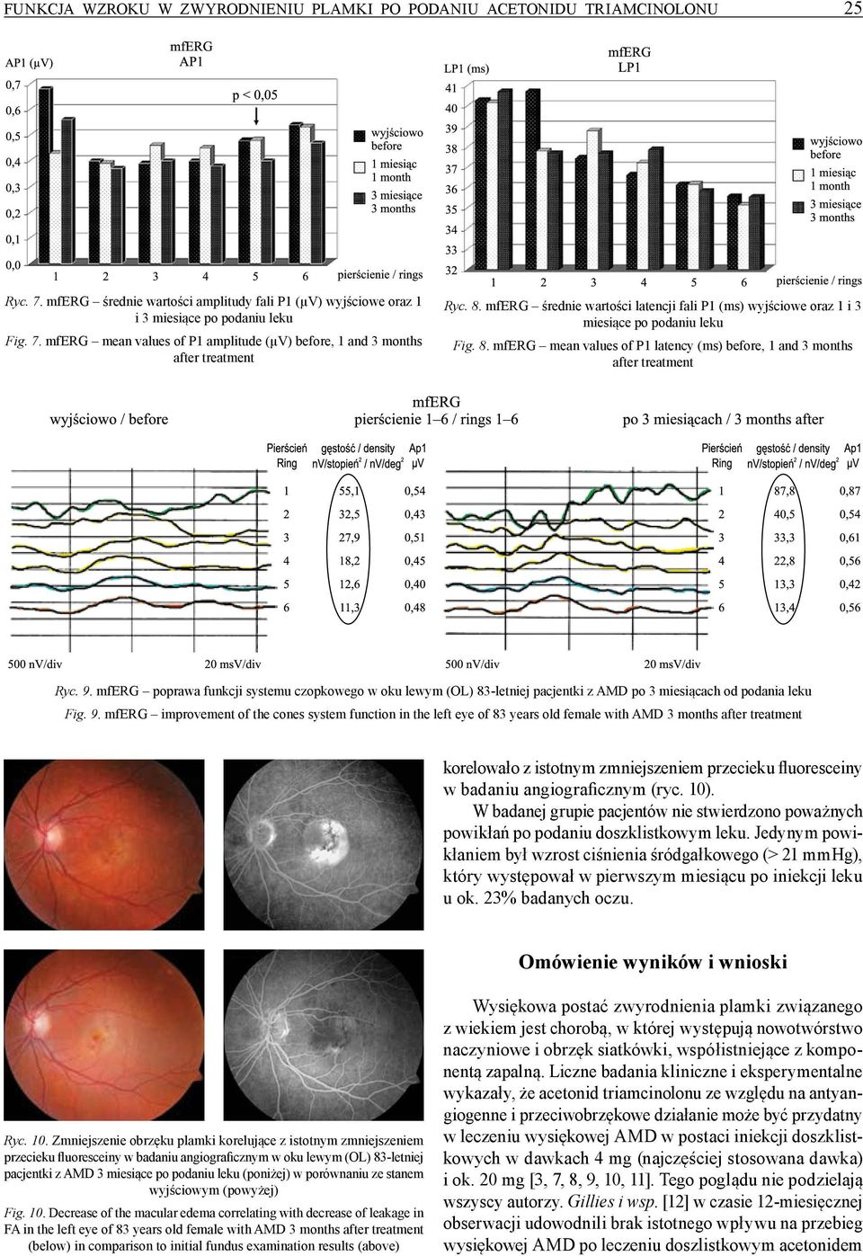 mferg poprawa funkcji systemu czopkowego w oku lewym (OL) 83-letniej pacjentki z AMD po 3 miesiącach od podania leku Fig. 9.