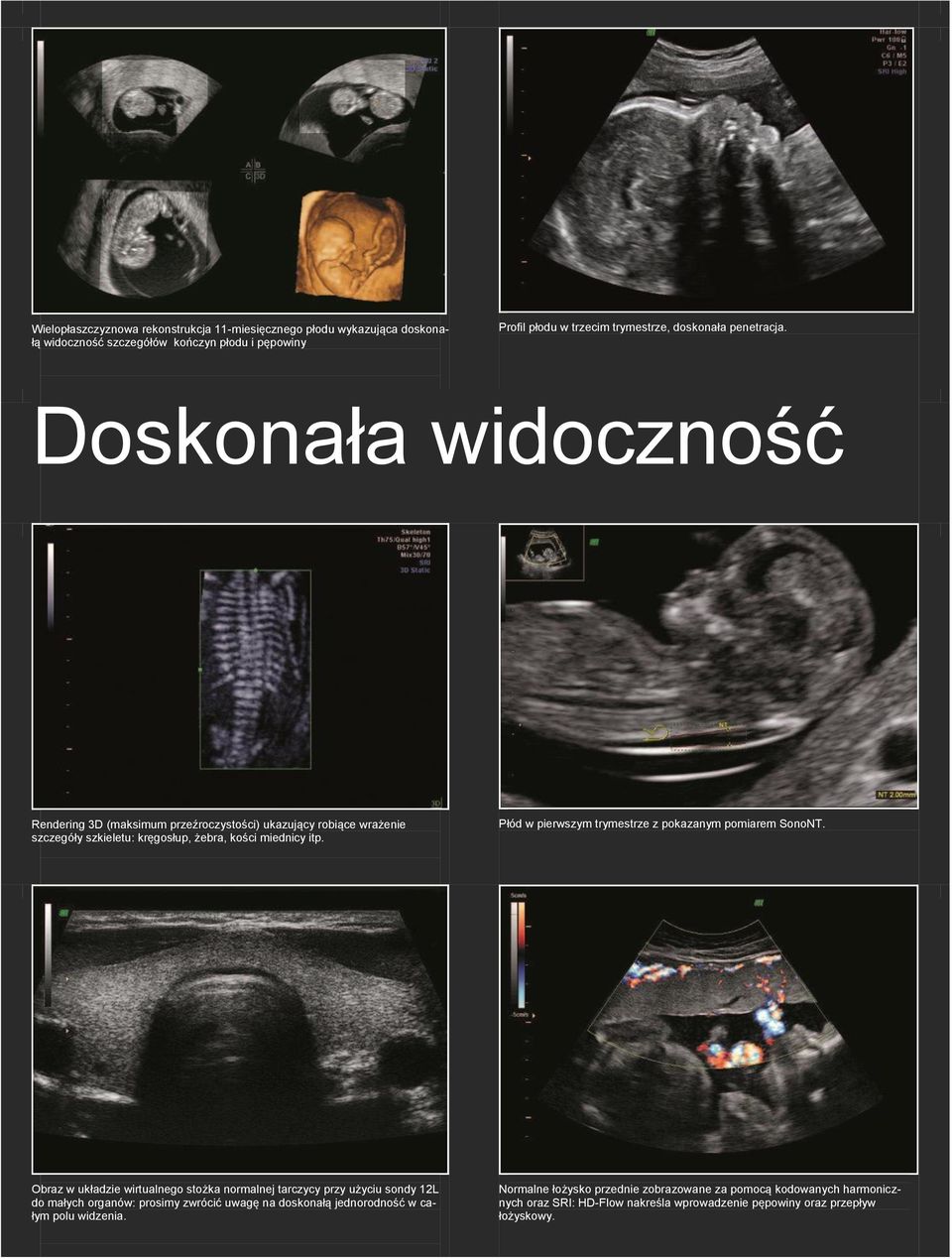 Płód w pierwszym trymestrze z pokazanym pomiarem SonoNT.